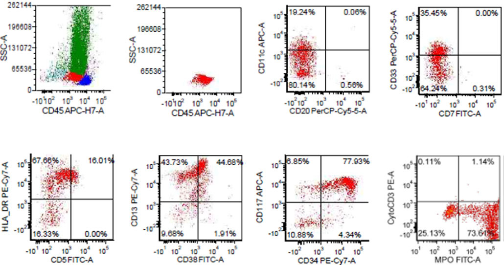 Approximately 10% myeloblasts were detected by flow cytometry, expressing CD34, CD13, CD117, MPO, and HLA-DR.